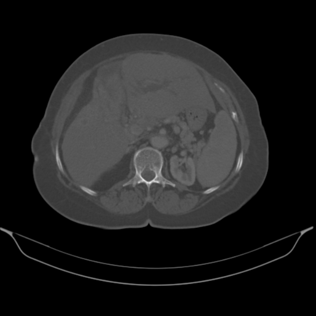 Cholangiocarcinoma (Radiopaedia 50592-56025 Axial bone window 26).jpg