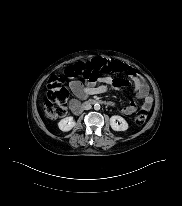 Cholangiocarcinoma with cerebral metastases (Radiopaedia 83519-98629 Axial C+ delayed 58).jpg