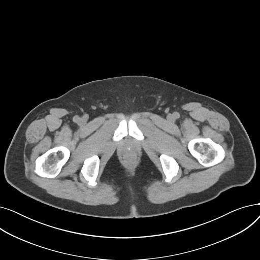 File:Cholecystitis with focal perforation and hepatic abscess (Radiopaedia 37189-38945 Axial non-contrast 88).png