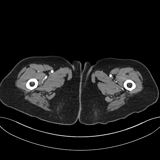 Cholecystoduodenal fistula due to calculous cholecystitis with gallstone migration (Radiopaedia 86875-103077 A 88).jpg