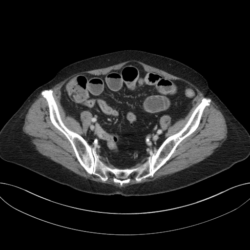 Cholecystoduodenal fistula due to calculous cholecystitis with gallstone migration (Radiopaedia 86875-103077 D 63).jpg