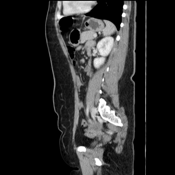 Choledocholithiasis on CT and MRI (Radiopaedia 24825-25087 D 41).jpg