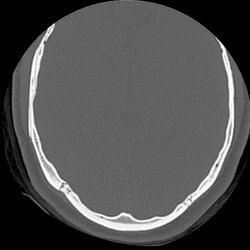 Cholesteatoma (Radiopaedia 84960-100474 Axial bone window 6).jpg
