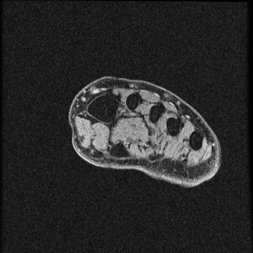 File:Chondroblastoma - midfoot (Radiopaedia 64831-73765 F 24).jpg