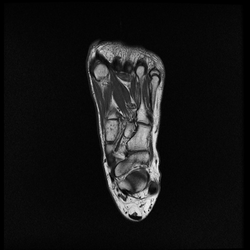 File:Chondroblastoma - midfoot (Radiopaedia 64831-73765 Long axis T1 11).jpg