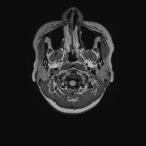 Chondrosarcoma (Radiopaedia 41937-44939 Axial FLAIR 3).png