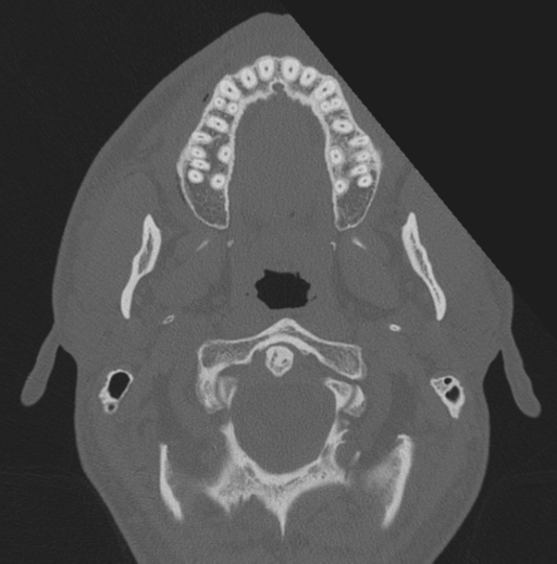 Chondrosarcoma (clivus) (Radiopaedia 46895-51425 Axial bone window 81).png