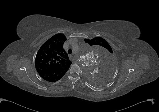 Chondrosarcoma - chest wall (Radiopaedia 65192-74199 Axial bone window 37).jpg