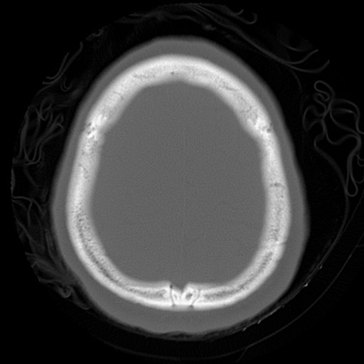 File:Chondrosarcoma - sphenoid wing (Radiopaedia 58259-67828 Axial bone window 24).jpg