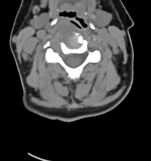 File:Chordoma (C4 vertebra) (Radiopaedia 47561-52188 Axial non-contrast 26).png