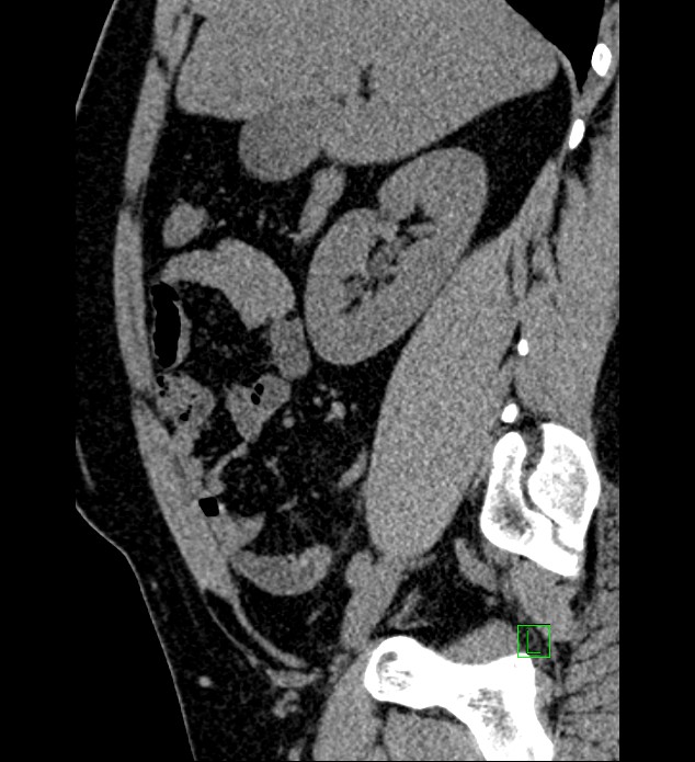 Chromophobe renal cell carcinoma (Radiopaedia 84286-99573 C 123).jpg
