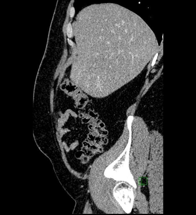 Chromophobe renal cell carcinoma (Radiopaedia 84286-99573 I 153).jpg