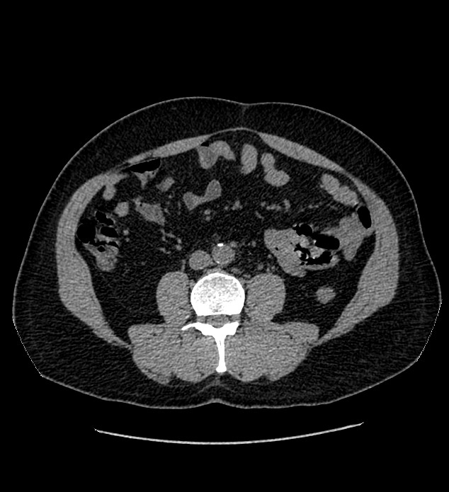 Chromophobe renal cell carcinoma (Radiopaedia 84337-99693 Axial non-contrast 81).jpg