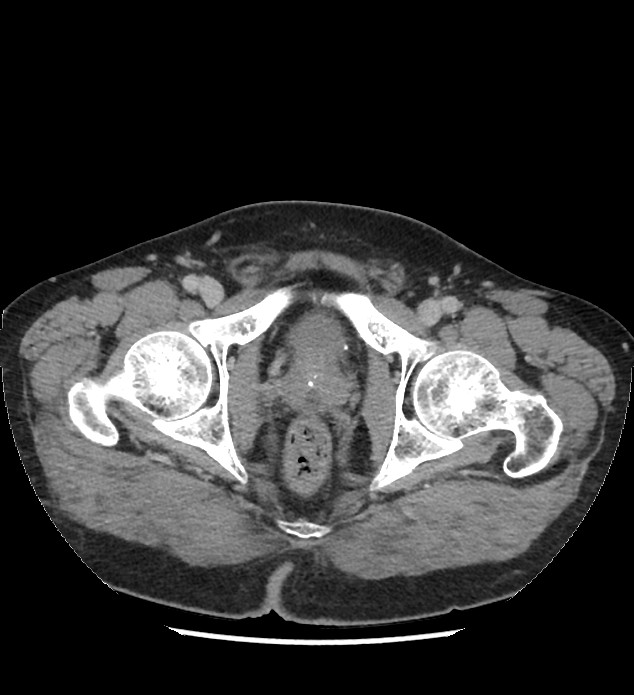 Chromophobe renal cell carcinoma (Radiopaedia 86879-103083 C 149).jpg