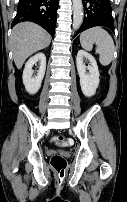 Chronic appendicitis complicated by appendicular abscess, pylephlebitis and liver abscess (Radiopaedia 54483-60700 C 57).jpg