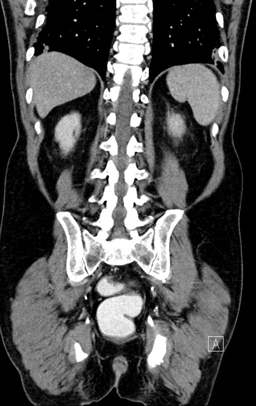 Chronic appendicitis complicated by appendicular abscess, pylephlebitis and liver abscess (Radiopaedia 54483-60700 C 64).jpg