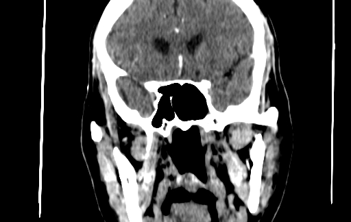 Chronic invasive fungal sinusitis (Radiopaedia 91563-109286 D 89).jpg