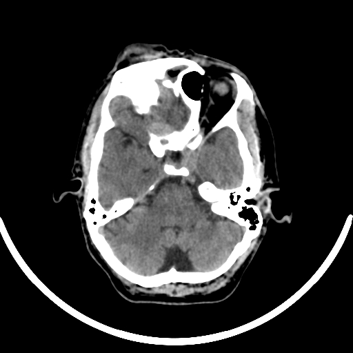 Chronic invasive fungal sinusitis with intraorbital and intracranial extension (Radiopaedia 56387-63046 Axial non-contrast 139).jpg