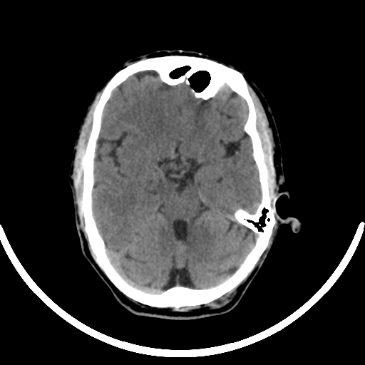 File:Chronic invasive fungal sinusitis with intraorbital and intracranial extension (Radiopaedia 56387-63046 Axial non-contrast 164).jpg