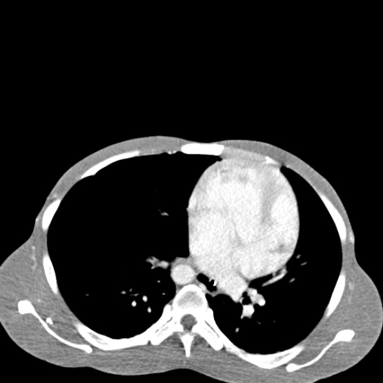 Chronic large bowel pseudo-obstruction (Radiopaedia 43181-46492 A 17).jpg