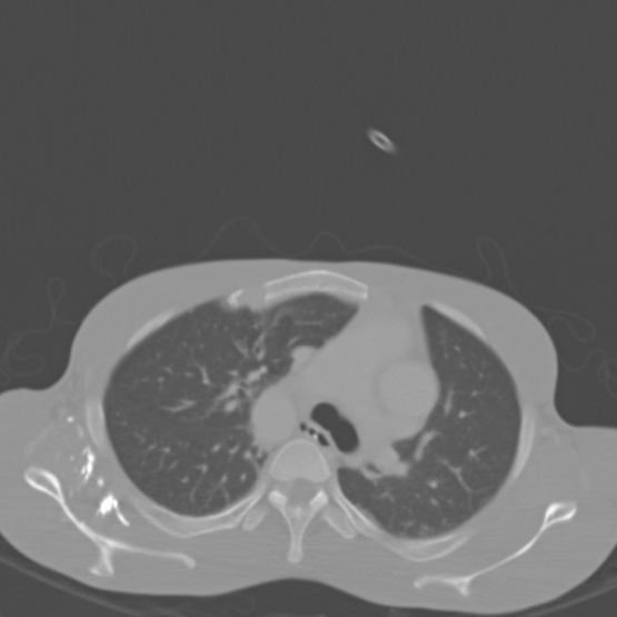 Chronic large bowel pseudo-obstruction (Radiopaedia 43181-46492 Axial bone window 2).jpg
