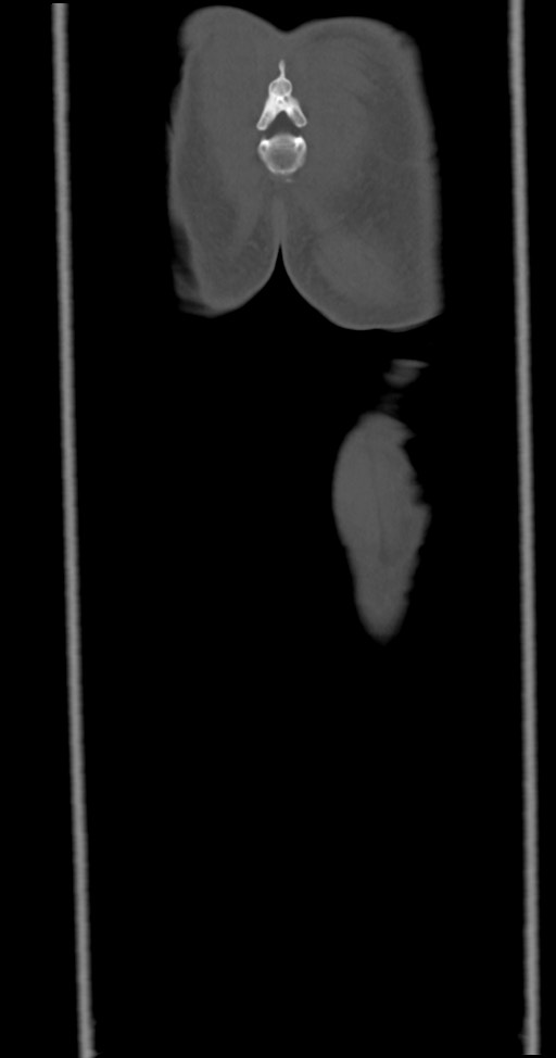 Chronic osteomyelitis (with sequestrum) (Radiopaedia 74813-85822 Coronal non-contrast 56).jpg