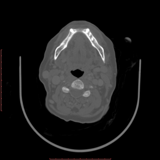 Chronic osteomyelitis - maxilla (Radiopaedia 23783-23927 Axial bone window 31).jpg