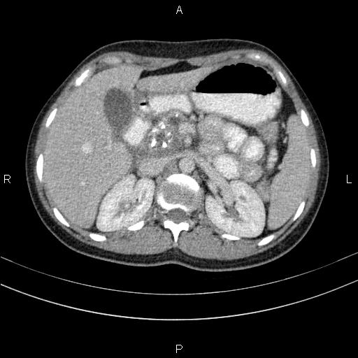 Chronic pancreatitis (Radiopaedia 64576-73450 C 45).jpg