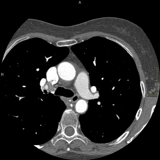 Chronic pulmonary embolism (Radiopaedia 73073-85094 Axial C+ CTPA 39).jpg