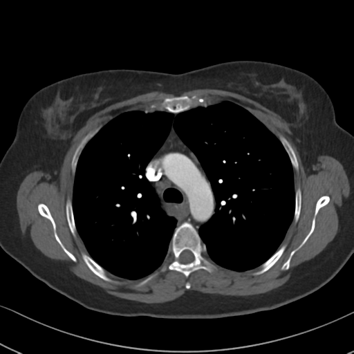 Chronic pulmonary embolus (Radiopaedia 39129-41341 Axial C+ CTPA 36).png