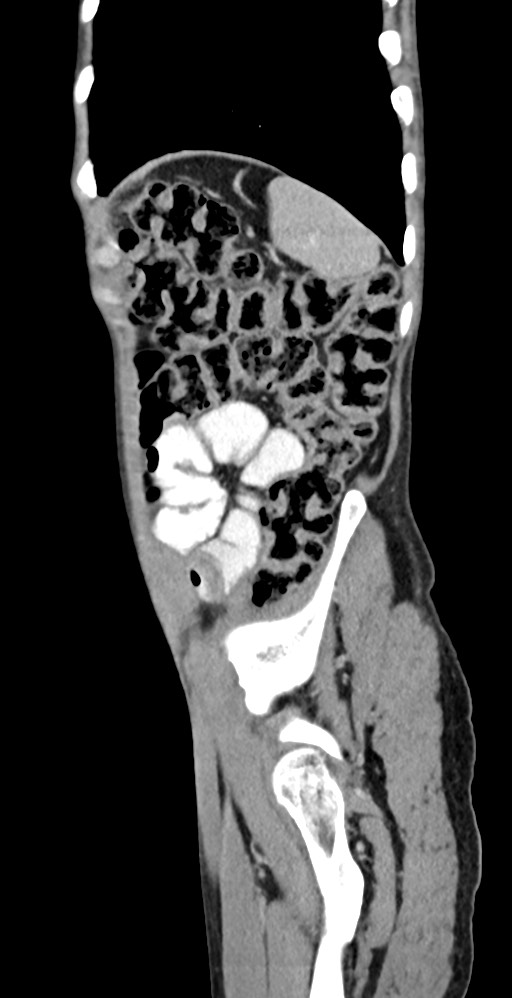 Chronic small bowel volvulus (Radiopaedia 75224-86322 C 30).jpg