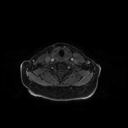 Chronic submandibular sialadenitis (Radiopaedia 61852-69885 Axial T1 C+ fat sat 15).jpg