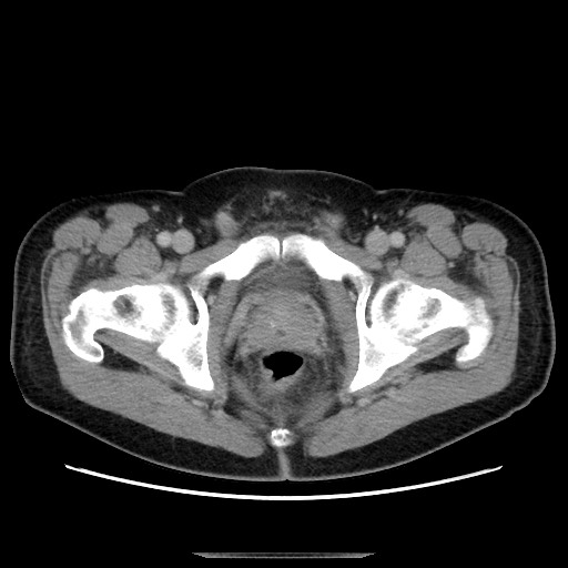 File:Chronic ureteropelvic junction obstruction (Radiopaedia 78365-90996 A 130).jpg