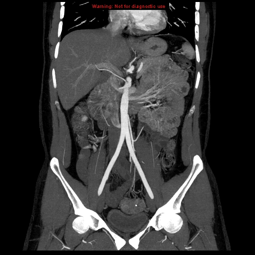 File:Circumaortic left renal vein (Radiopaedia 9069-9792 B 14).jpg