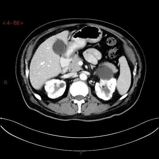 File:Circumaortic left renal vein and doubled left renal arteries (Radiopaedia 52268-58158 B 18).jpg