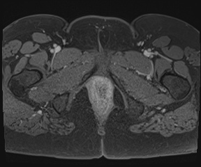 File:Class II Mullerian duct anomaly- unicornuate uterus with rudimentary horn and non-communicating cavity (Radiopaedia 39441-41755 Axial T1 fat sat 140).jpg