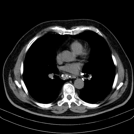 File:Classic complicated silicosis (Radiopaedia 49720-54961 Axial liver window 31).jpg
