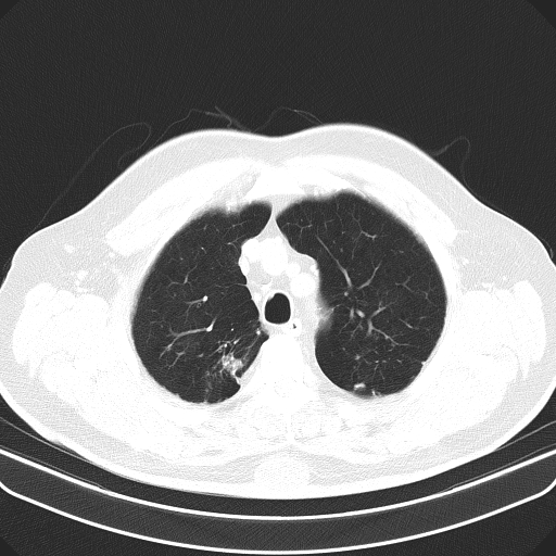 Classic complicated silicosis (Radiopaedia 49720-54961 Axial lung window 11).jpg