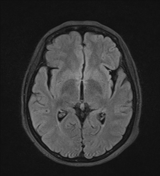 File:Clival meningioma (Radiopaedia 53278-59248 Axial FLAIR 12).jpg