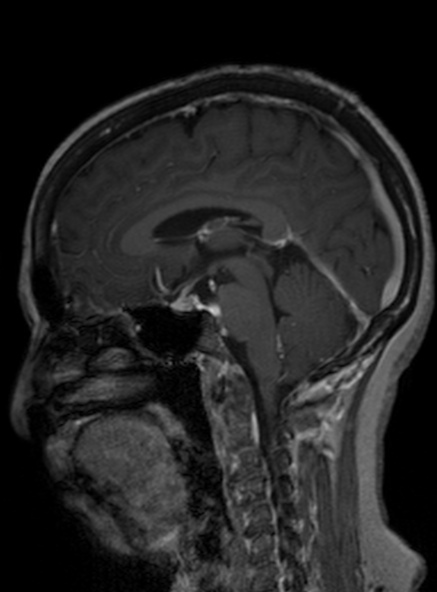 Clival meningioma (Radiopaedia 53278-59248 Sagittal T1 C+ 256).jpg