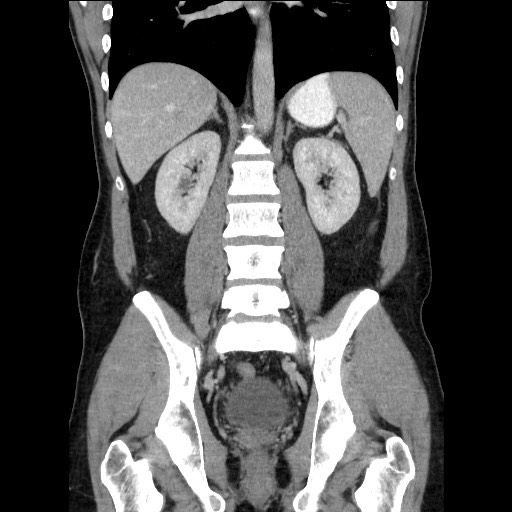 Closed-loop small bowel obstruction (Radiopaedia 73713-84509 C 81).jpg