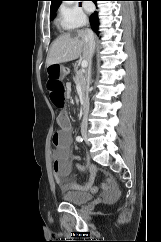 Closed loop bowel obstruction and ischemia (Radiopaedia 86959-103180 C 37).jpg