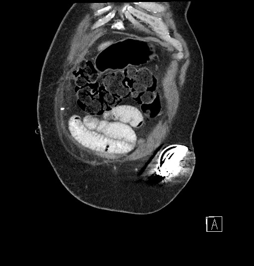 Closed loop obstruction - internal hernia into nephrectomy bed (Radiopaedia 59867-67320 B 6).jpg