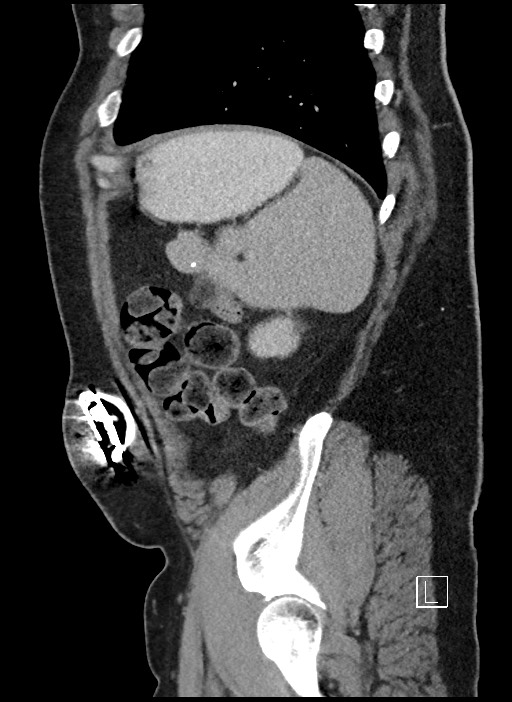 Closed loop obstruction - internal hernia into nephrectomy bed (Radiopaedia 59867-67320 C 9).jpg