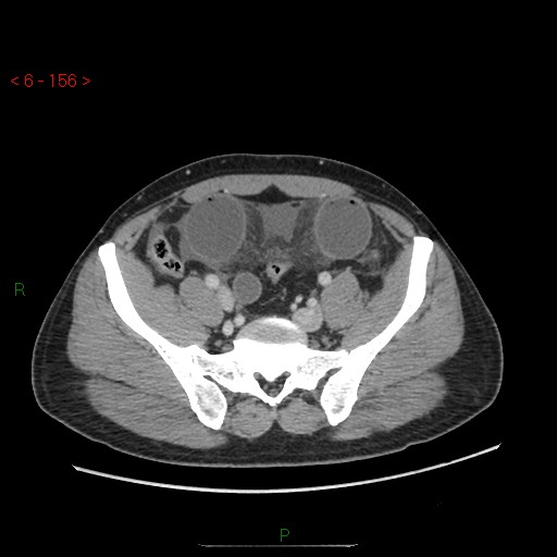 Closed loop obstruction and appendicular stump mucocele (Radiopaedia 54014-60163 A 92).jpg
