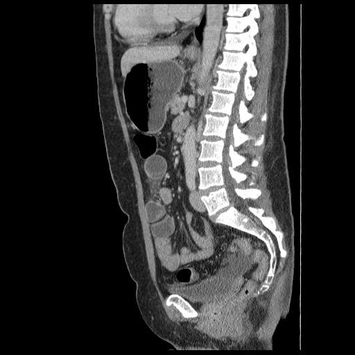 Closed loop small bowel obstruction (Radiopaedia 65403-74451 C 57).jpg