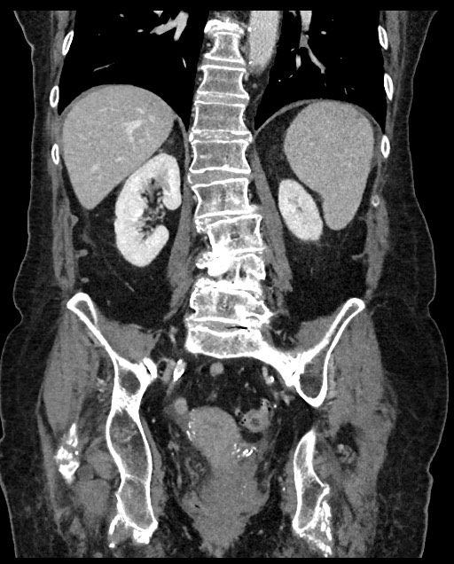 Closed loop small bowel obstruction - adhesions (Radiopaedia 59269-66611 B 84).jpg