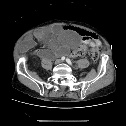 File:Closed loop small bowel obstruction - adhesive disease and hemorrhagic ischemia (Radiopaedia 86831-102990 A 128).jpg