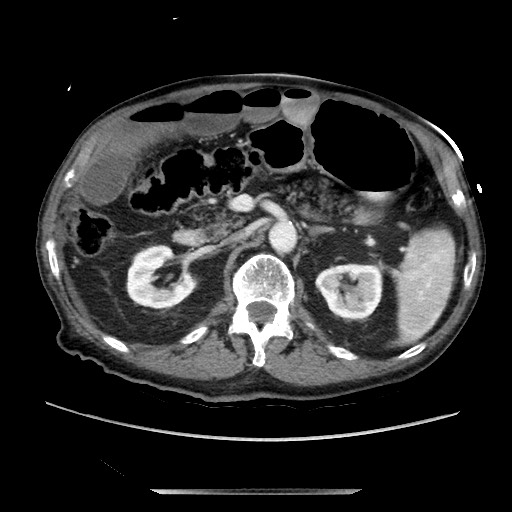 Closed loop small bowel obstruction - adhesive disease and hemorrhagic ischemia (Radiopaedia 86831-102990 A 77).jpg
