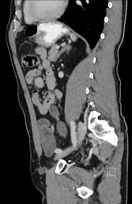 Closed loop small bowel obstruction - internal hernia (Radiopaedia 57806-64778 C 43).jpg